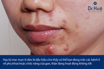 Bị mụn ở cằm là dấu hiệu của bệnh gì - Tại sao và cách điều trị