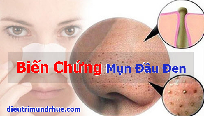 Hoảng sợ với 4 biến chứng tai hại mà mụn đầu đen gây ra