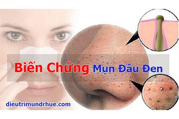 Hoảng sợ với 4 biến chứng tai hại mà mụn đầu đen gây ra