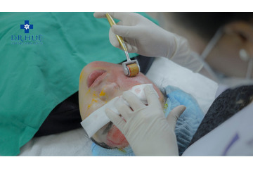 Hỏi – Đáp cùng Bác sĩ: Lăn kim ở đâu tốt nhất?