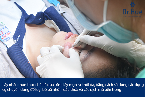 [Hỏi - Đáp] Lấy Nhân Mụn Có Hết Mụn Không?