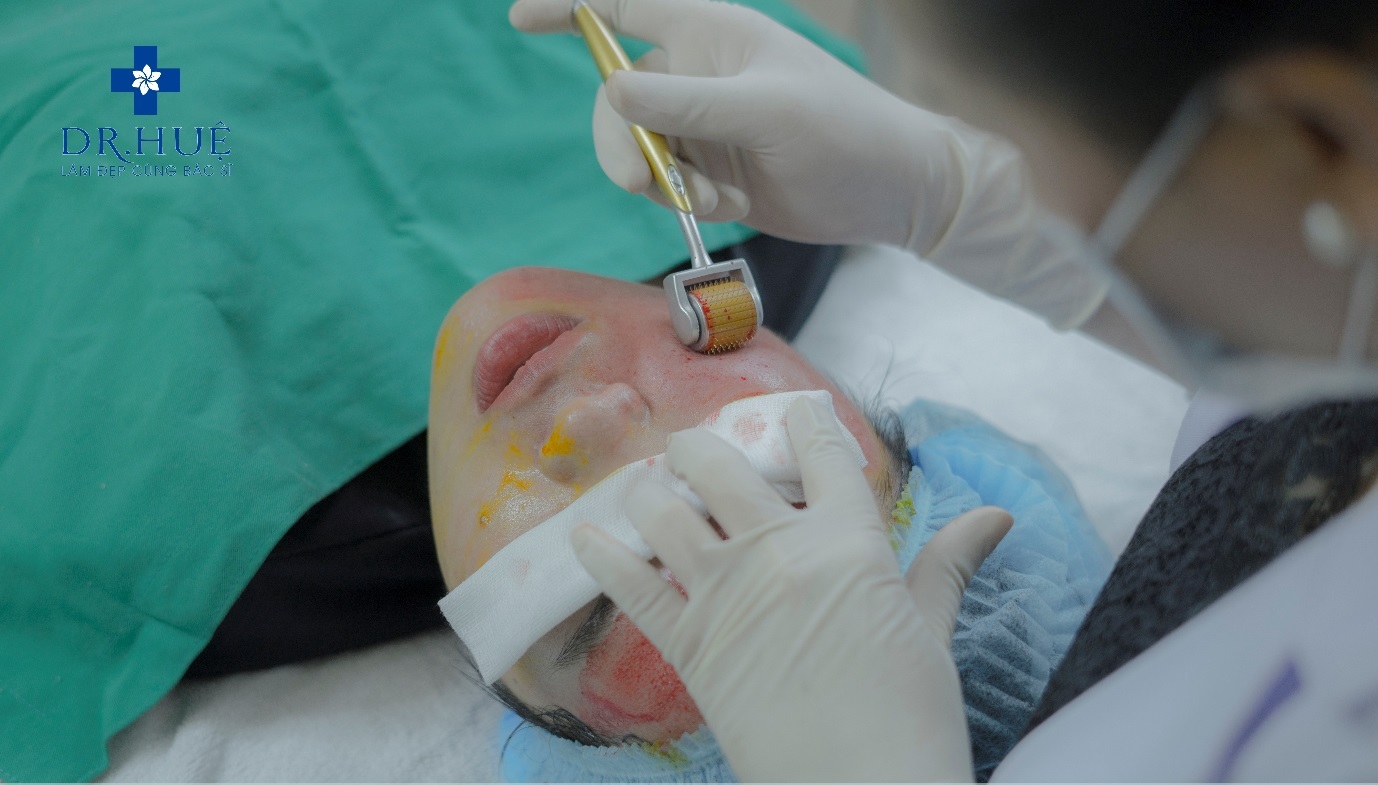 Hỏi nhanh đáp gọn: Nano Basic trị mụn được không?