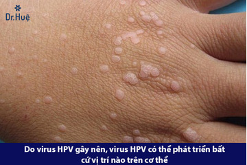 Hướng dẫn cách chữa mụn hạt cơm bằng lá tía tô