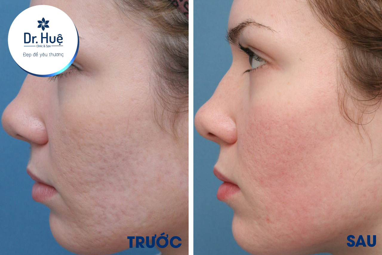 [Top 6] Phương pháp hướng dẫn cách chữa sẹo rỗ sau mụn tại nhà từ thiên nhiên