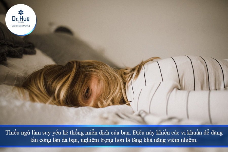 Thiếu ngủ là nguyên nhân nổi mụn