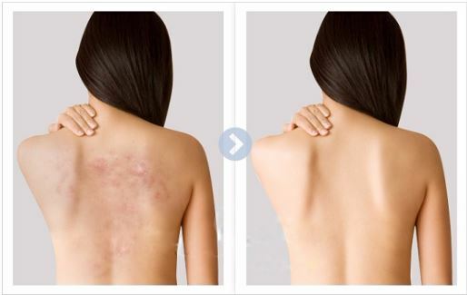 Điều trị mụn lưng hiệu quả nhanh chóng - Hình 2