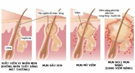 Điều trị mụn lưng hiệu quả nhanh chóng - Hình 3