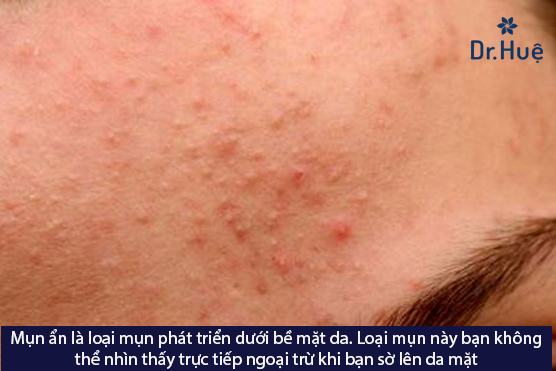 Không nặn mụn ẩn có hết không và có nên đi spa nặn mụn ẩn không