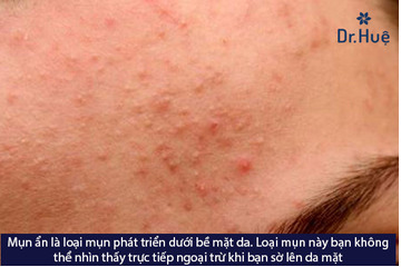 Không nặn mụn ẩn có hết không và có nên đi spa nặn mụn ẩn không