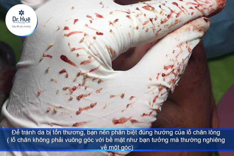 Nên xác đinh hướng nhân mụn trước khi nặn mụn 