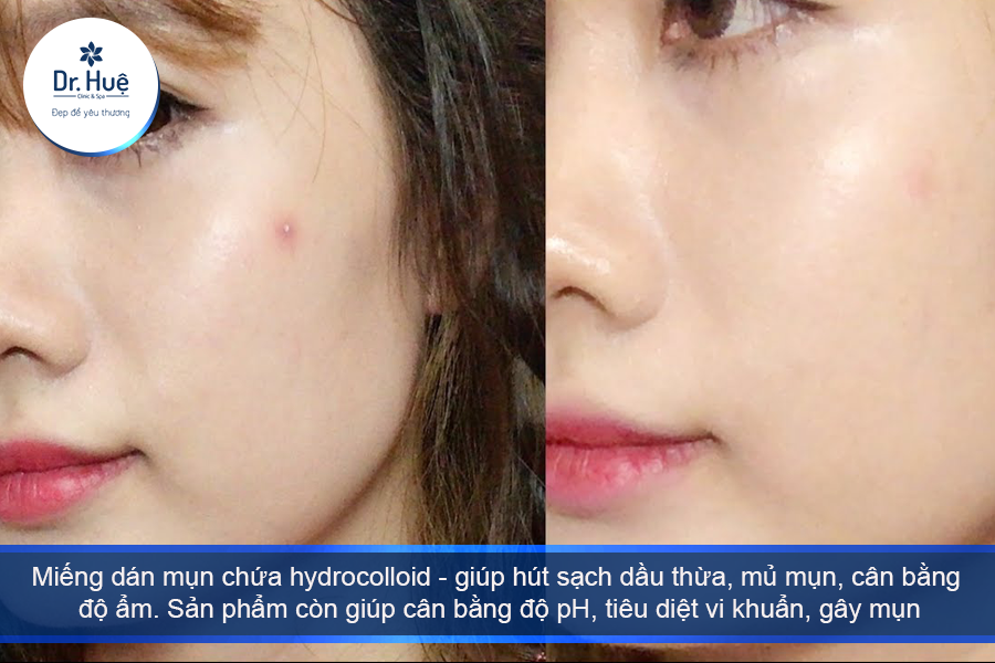 Làm sao để hết mụn bọc trong 1 đêm nhanh nhất