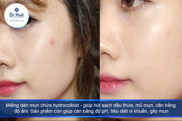 Làm sao để hết mụn bọc trong 1 đêm nhanh nhất