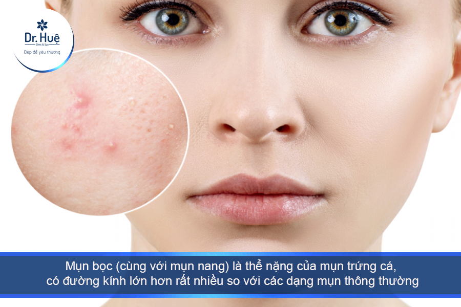 Mụn bọc là một dạng của mụn trứng cá 