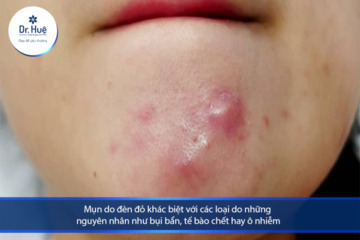 Làm sao để không bị mụn khi đến tháng ngày đèn đỏ