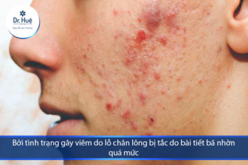 Làm sao để không có mụn ở tuổi dậy thì