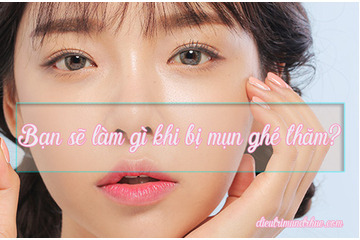 Làm thế nào khi bạn bị mụn ghé thăm