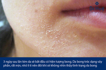 Nano Basic Sau Mấy Ngày Thì Bong Da - Bao Lâu Thì Hết Đỏ Da Trở Lại Bình Thường