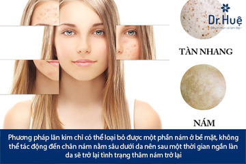 Nano Basic Trị Nám Tàn Nhang Có Hết Không Có Tốt Không