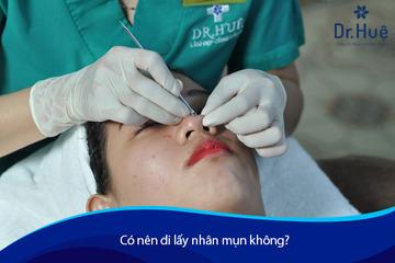 Lấy Nhân Mụn Có Tốt Không - Có Nên Đi Lấy Nhân Mụn Không