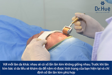 Liệu trình Nano Basic bao nhiêu lần – một lần có tốt không không?