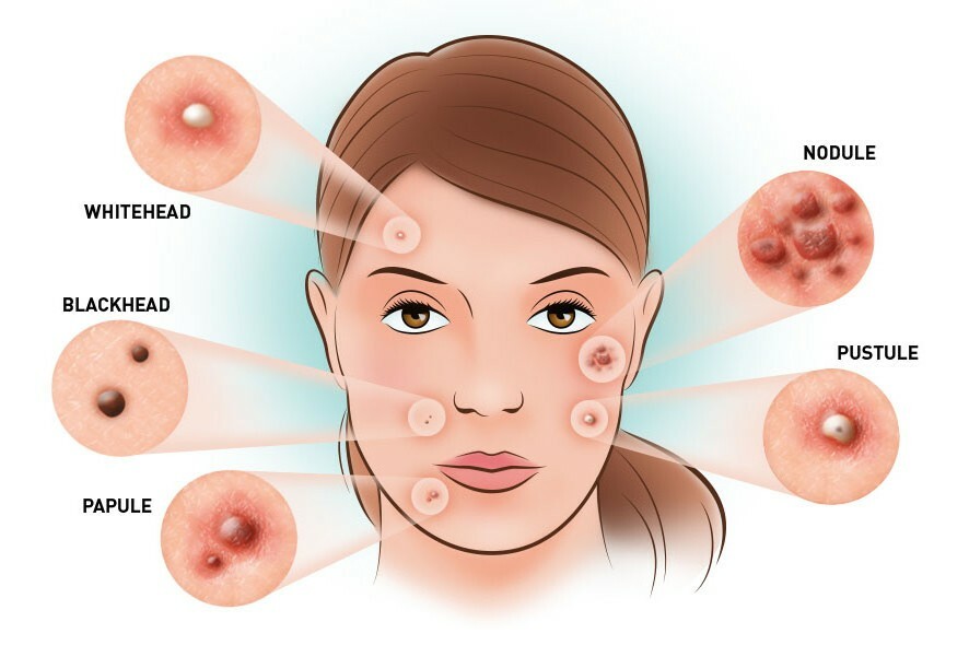 Loại mụn nào sinh viên hay gặp phải nhất!