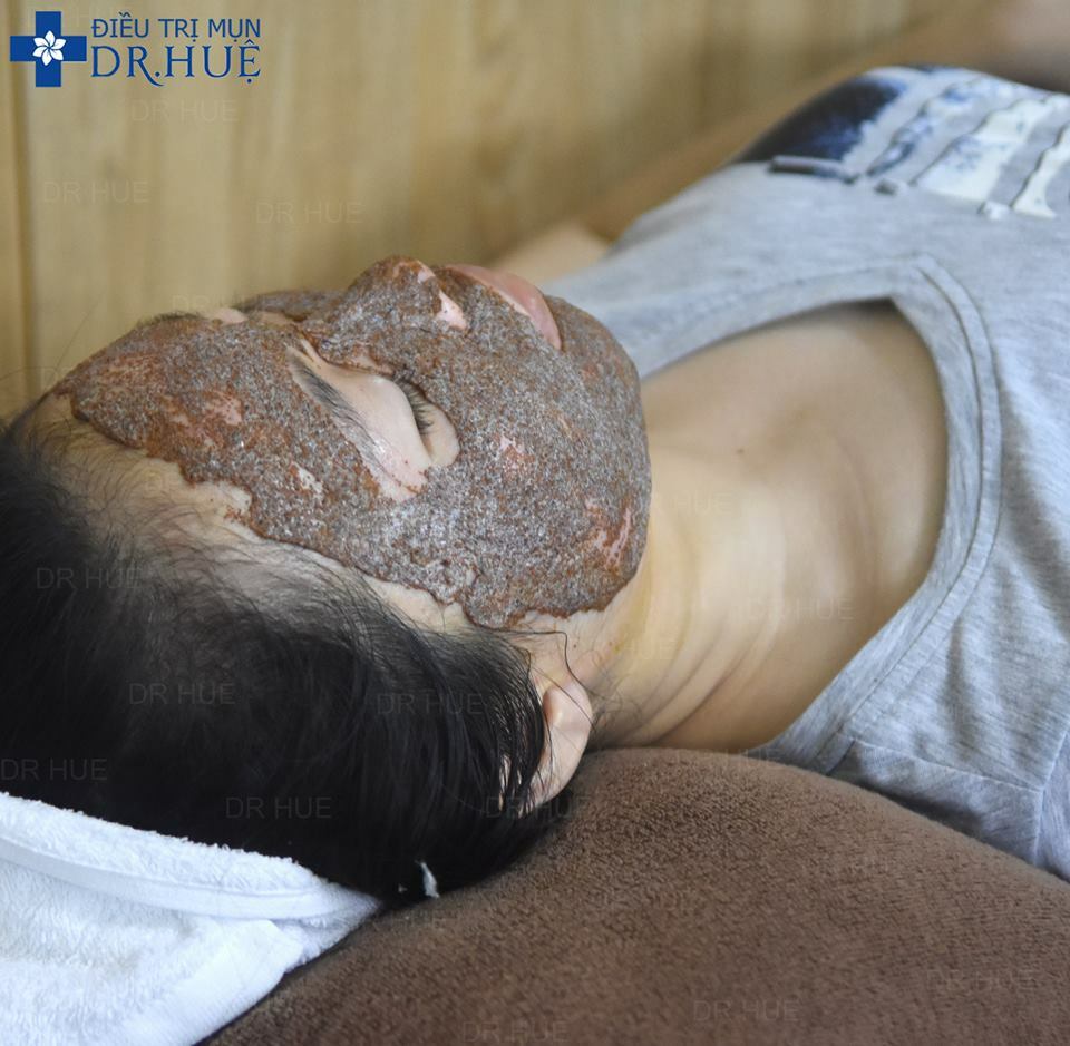LIỆU TRÌNH ĐẮP MẶT NẠ COLLAGEN TƯƠI - Điều trị mụn Dr Huệ - Hình 2