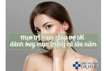 Mẹo trị mụn giúp vợ tôi đánh bay mụn trứng cá lâu năm