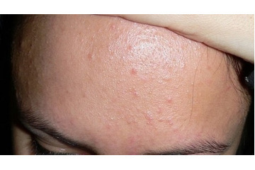 MỤN ẨN DƯỚI DA CÓ NẶN ĐƯỢC KHÔNG?