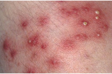 Mụn bọc có mủ, làm sao tiêu diệt?