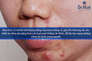 Mụn Bọc Mụn Mủ Có Nên Nặn Hay Không?