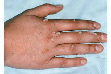 Mụn cóc là gì? Những lưu ý khi điều trị mụn cóc