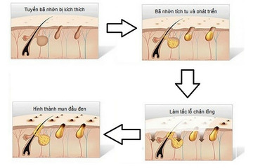 Mụn đầu đen để lâu có thành nốt ruồi không?