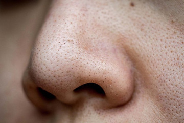 Mụn đầu đen để lâu sẽ trở thành nốt ruồi