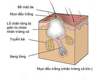 Mụn đầu đen, mụn cám là gì, nguyên nhân và cách điều trị