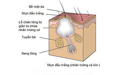 Mụn đầu đen, mụn cám là gì, nguyên nhân và cách điều trị