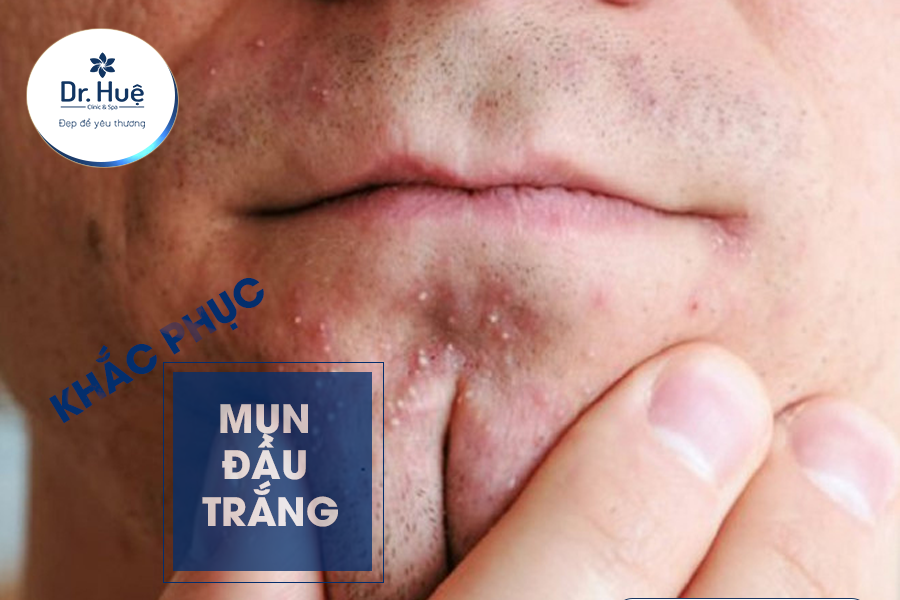 Khắc phục mụn đầu trắng 