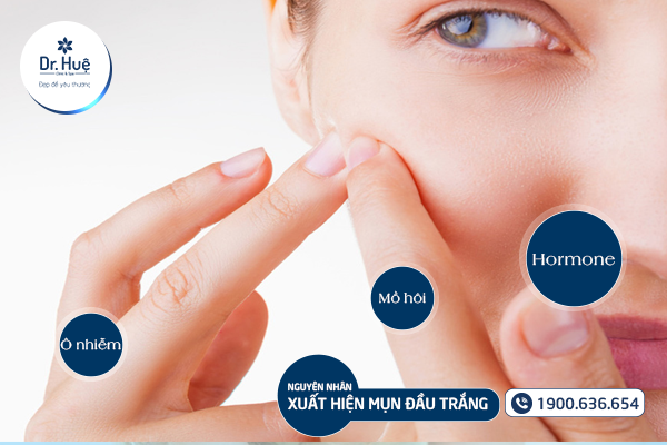 Mụn đầu trắng là gì? Nguyên nhân hình thành và cách chữa trị