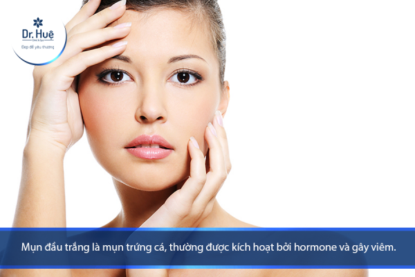 Mụn đầu trắng là gì tại sao nổi mụn đầu trắng và cách trị