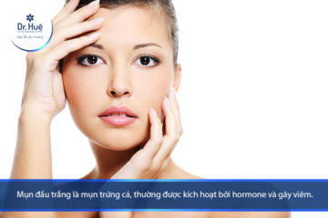 Mụn đầu trắng là gì tại sao nổi mụn đầu trắng và cách trị