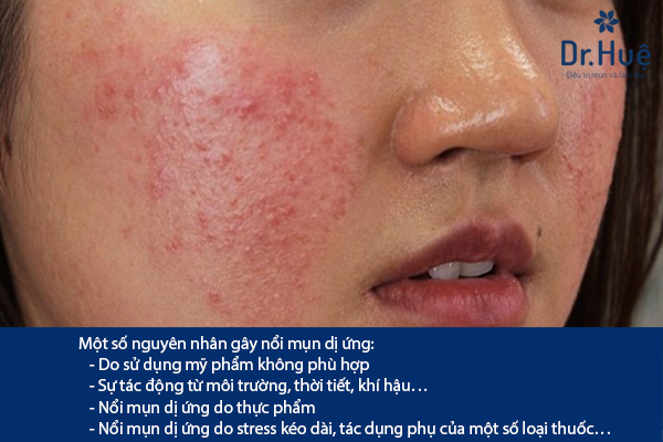 Mụn dị ứng là mụn như thế nào - Cách trị mụn dị ứng