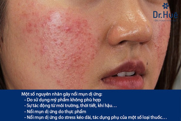 Mụn dị ứng là mụn như thế nào - Cách trị mụn dị ứng