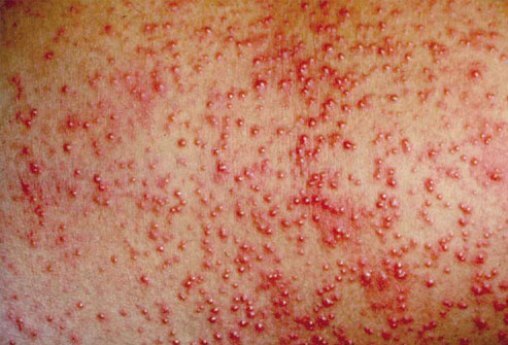 Mụn do dị ứng mỹ phẩm – Làm sao điều trị?