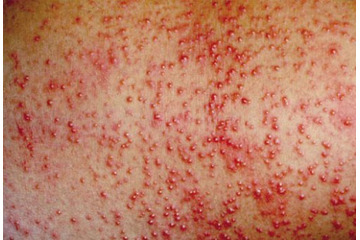 Mụn do dị ứng mỹ phẩm – Làm sao điều trị?