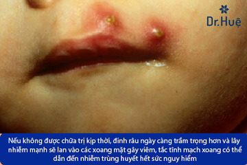 Mụn Đinh Râu Có Nguy Hiểm Không - Bao Lâu Thì Khỏi