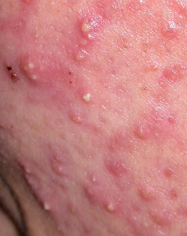 Mụn là gì? Nguyên nhân hình thành các loại mụn - Điều trị mụn Dr Huệ - Hình 3