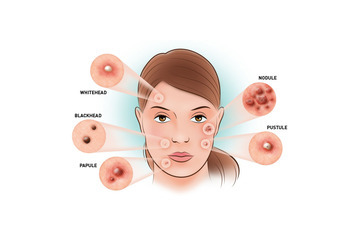 Mụn là gì? Nguyên nhân hình thành các loại mụn