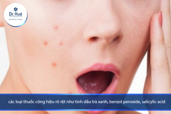 Mụn lây lan: làm cách nào để hết