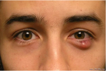 Mụn lẹo là gì? Cách điều trị mụn lẹo hiệu quả?