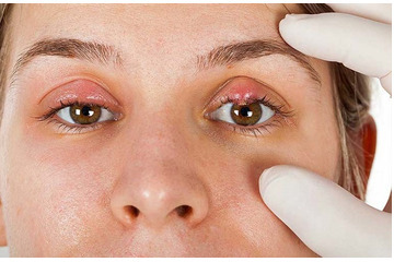 Mụn lẹo là gì? Cách điều trị mụn lẹo ở mắt hiệu quả?