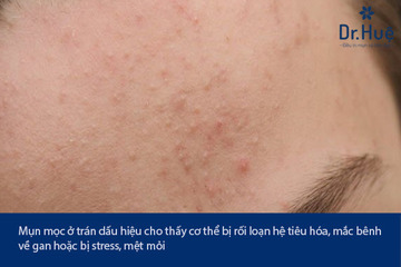 Mọc Mụn Ở Trán Là Bệnh Gì - Nguyên Nhân Và Cách Điều Trị